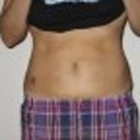 1 week after smart lipo - front